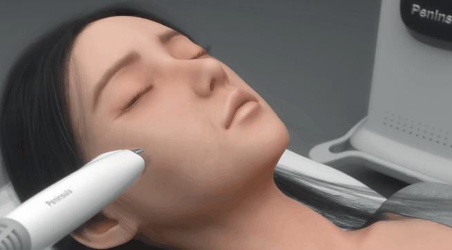 五代微针面部.gif 五代微针面部.gif